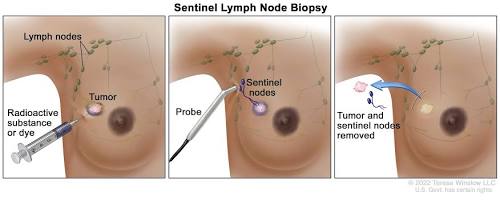 Step-by-step process of sentinel lymph node biopsy by National Cancer Institute