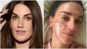 Priyanka Chopra's facialist accused of 'burning and permanently  disfiguring' woman's face in skin treatment gone wrong