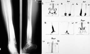 Image result for Osteomyelitis Bone Scan