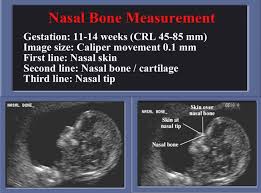 Short Nasal Bone