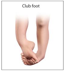 Image result for Clubfoot