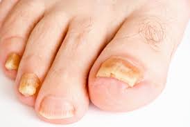 Image result for onychomycosis