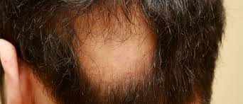 Without treatment, however, the hair loss and scaling may spread to other parts of the scalp. Ringworm Alopecia Areata Dr Abdullah Unal Klinigi