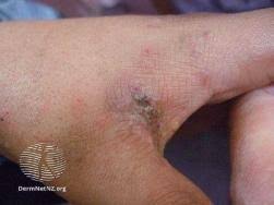 Image result for scabies transmission