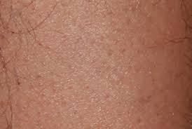 It takes more than one treatment to affect all the follicles growing in an area. Facial Laser Hair Removal In Weston Fl Weston Med Spa