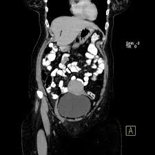 They are important in planning for certain types of therapy and surgery, as well as in the aftermath to determine whether the patient's body is responding to treatment. Thickened Round Ligament Endometriosis Radiology Case Radiopaedia Org