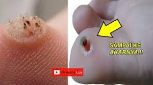 Jadi, secara otomatis sari cuka apel juga bisa digunakan untuk menghilangkan mata ikan. Cara Ampuh Menghilangkan Mata Ikan Sampai Ke Akarnya Youtube