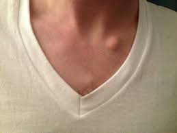 Доброкачественные опухоли кожи, опухолевидные пролиферации тканей кожи развиваются в большинства случаев безболезненно в виде одиночных или множественных узлов либо разрастаний. Shishka Na Grudine U Muzhchin I Zhenshin Prichiny S Foto Lechenie Pro Kozhu