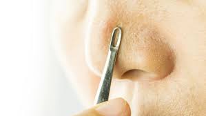 Blackhead dapat diatasi melalui ekstraksi yang penyembuhannya justru lebih cepat. 9 Cara Menghilangkan Komedo Bandel Yang Mengganggu