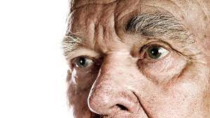 Rhinophym it eine form von roacea, die hauptächlich da ende der nae betrifft und eine extreme verdickung und rötung der haut veruracht. á… Rhinophym Auspragung Und Behandlung Der Knollennase