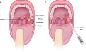 Image result for Peritonsillar Abscess