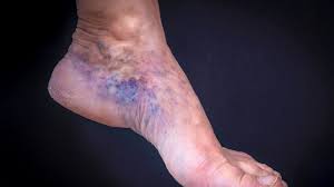 Thrombose Symptome Behandlung Und Ursachen