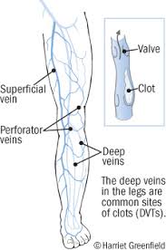 Because blood clots block the veins, thus preventing natural blood flow, your blood tends to pool up in the areas where the clot is located. Deep Vein Thrombosis Blood Clots In Your Veins Harvard Health