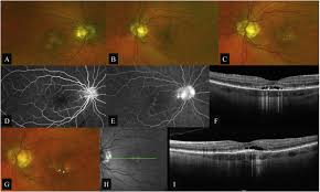 Apmppe affects otherwise young healthy adults and presents as a disorder affecting the retina, retinal pigment epithelium and choroid. An Atypical Case Of Acute Posterior Multifocal Placoid Pigment Epitheliopathy With Recurrent Strokes Sciencedirect