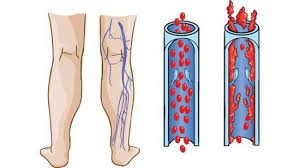 Will the blood clot in my leg go away now that i am on medication for it? How To Dissolve A Deep Vein Thrombosis Naturally Deep Vein Thrombosis Natural Prevention Life Extension Organically Dr Sarah Larsen Medical Intuitive And Energy Healer