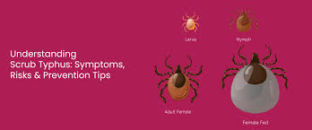 Image result for Typhus