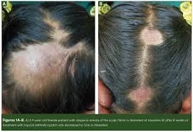 Image result for Anthralin