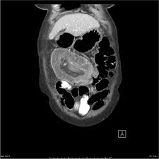 Image result for Adult Intussusception