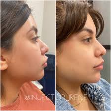 Irene Ware- Nurse Injector