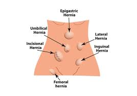 A doctor can often move an inguinal inguinal hernias are relatively common. Inguinal Hernia Top O C Surgery Center Crown Valley Surgical