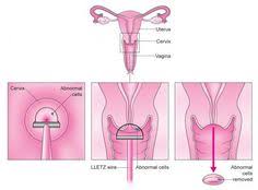They say google is your worst enemy when it comes to looking up your symptoms, but in my case. Cervical Cancers