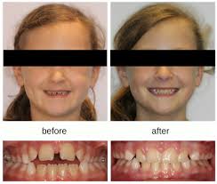 Jul 06, 2021 · adults can choose clear or invisible braces to fix malocclusion of teeth many adults live their lives with crooked teeth and think nothing of it. Kids And Crossbites Hometown Orthodontics
