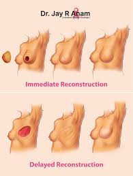 Image result for Mastectomy
