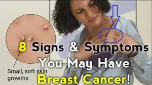 Irritation or dimpling of breast skin. Signs Symptoms You May Have Breast Cancer Youtube