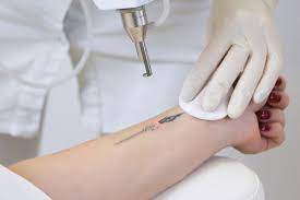 Carefully follow these laser tattoo removal aftercare instructions to help you to lower the risk of undesired side effects. Can Laser Tattoo Removal Cause Cancer Baird Md