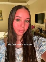 I looked like a tomato for a week and felt like my face was going to  explode