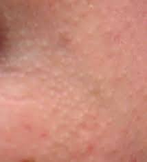 How Do I Get Rid Of These Small White Spots On My Face Skincareaddiction