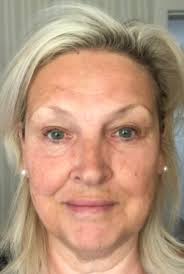 My acne journey has been a long and uncomfortable one. Finding my  confidence after struggling with acne for 10 years is so refreshing and it  feels so good 🥰 wishing this kind