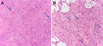 Mucormycosis is a threat to sight and even life but often presents with nonspecific symptoms. Acute Invasive Fungal Rhinosinusitis Frozen Section Histomorphology And Diagnosis With Pas Stain Springerlink