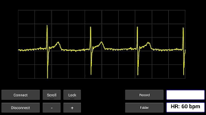 Android Smartphone User Interface During Ecg Signal Monitoring Download Scientific Diagram