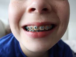 Check spelling or type a new query. How To Financially Brace For Orthodontia