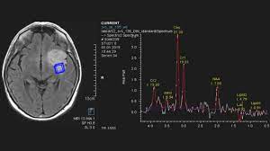 Astrozytom Und Oligodendrogliom Neurochirurgie Inselspital