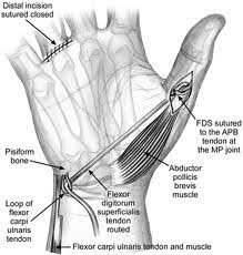 Tendon Transfer Principles Hand Orthobullets