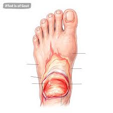 Image result for gout