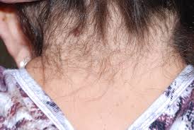 Image result for Webbed Neck