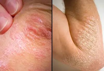 Skin flare-up close-up