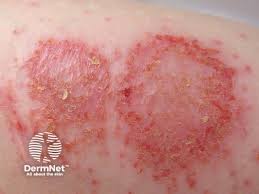 Image result for Eczema nummulare