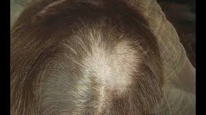 Psychemedics' standard screen, along with gc/ms/ms or lc/ms/ms confirmation, usually requires a cosmetically. Woman Says Company Drug Test Left Her With Big Bald Spot Fox61 Com