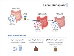 Image result for Fecal Transfer