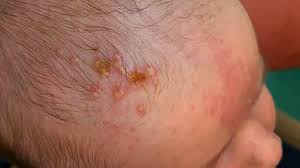 Symptoms can be managed with antiviral medication such as acyclovir, famciclovir a picture of trichomoniasis rash in the cervix. Herpes Rash In Newborn 20 Zher Migroup Pro