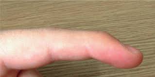 This joint is often injured during activities such as baseball. Mallet Finger Baseball Finger
