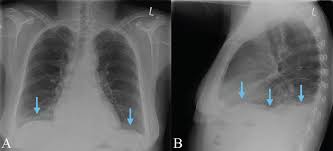 The annual incidence of pleural effusion in the developed world has been estimated at 320 per 100,000 population per year 1. Pocus For Pleural Assessment And Intervention Pocus Journal