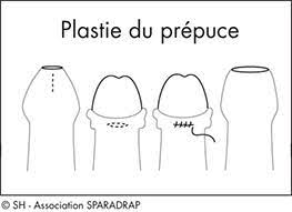 Start studying il a quel age. Decalotter Ou Pas Mon Petit Garcon Sparadrap