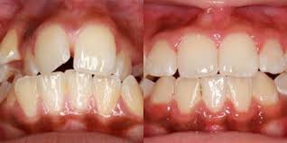 How long will it take for braces to straighten your teeth? Anyone Using Used The Gold Chain Method To Pull Down Impacted