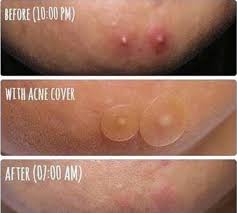 Apr 18, 2020 · the takeaway here is to patch test. Battle Of The Pimple Patches Style Story