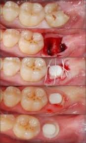 Normal healing tooth extraction pictures. How Long To Recover After Dental Implant Surgery